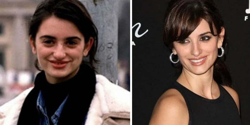 7 casos exitosos de cirugías plasticas de celebridades