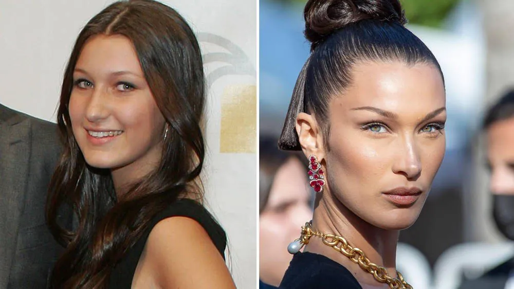 7 casos exitosos de cirugías plasticas de celebridades