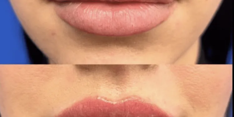 Le "Laser Lip FIip" est le nouveau moyen sans aiguille de repulper les lèvres fines