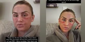 LaLa Kent partage des photos « après » meurtries de son alternative de remplissage sous les yeux