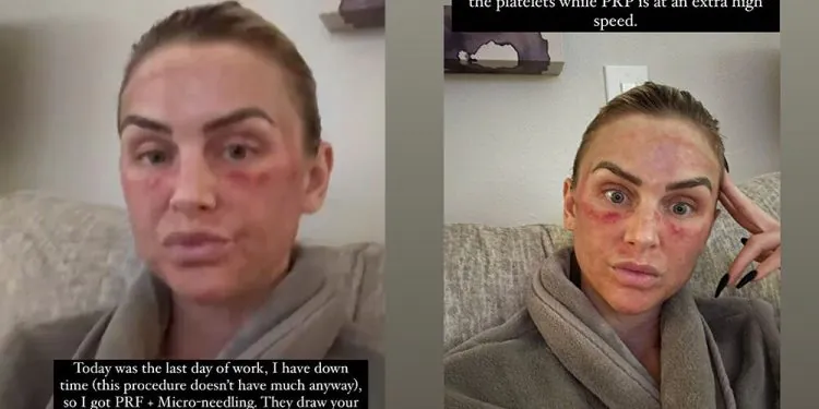 LaLa Kent partage des photos « après » meurtries de son alternative de remplissage sous les yeux