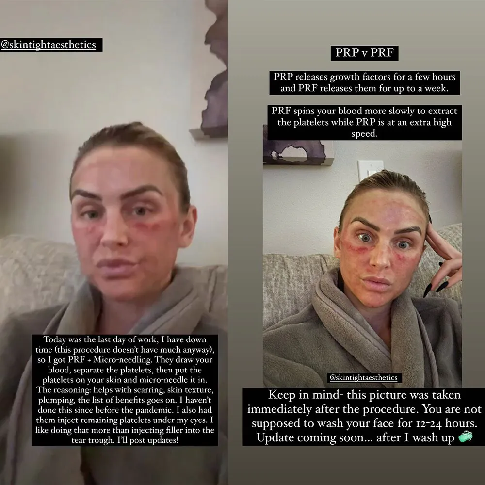 LaLa Kent partage des photos « après » meurtries de son alternative de remplissage sous les yeux