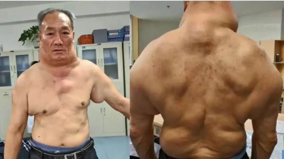 Il boit 1 litre d'alcool par jour depuis qu'il a 13 ans, voici le résultat sur son corps !
