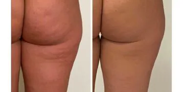 Qu'est-ce que la thérapie par endosphères et vous convient-elle ?