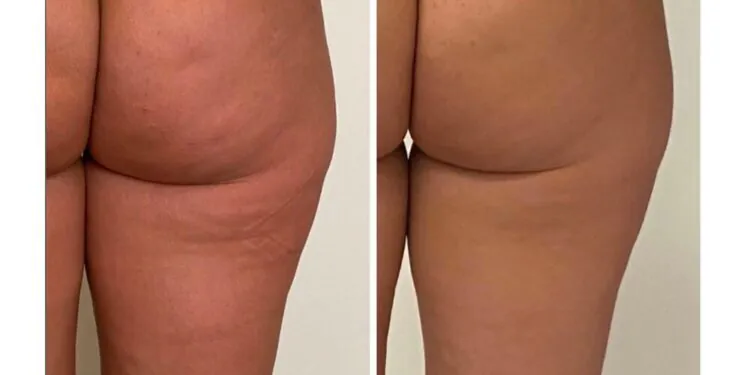 Qu'est-ce que la thérapie par endosphères et vous convient-elle ?