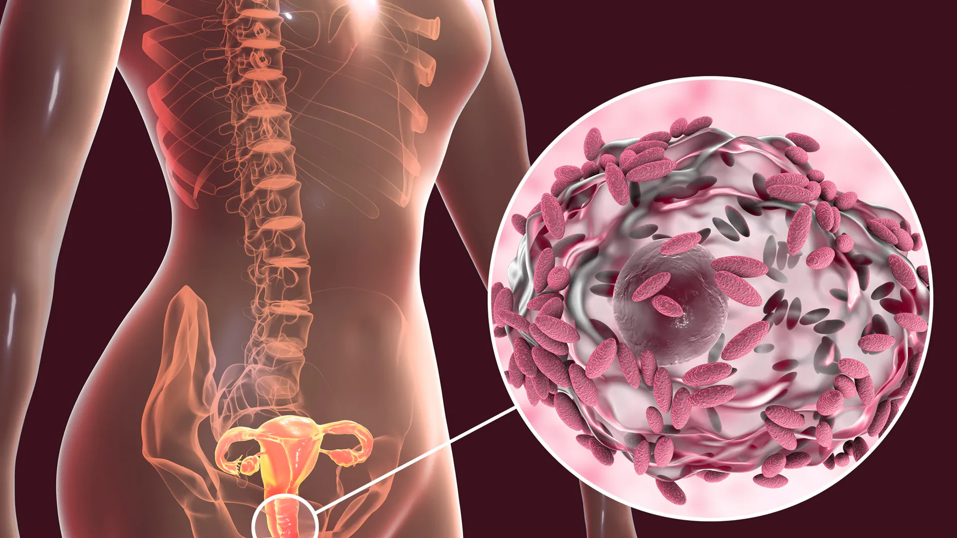 Vaginose bactérienne, illustration informatique. Système reproducteur féminin et bactéries Gardnerella vaginalis (bâtonnets) attachées aux cellules épithéliales vaginales, appelées cellules indices.