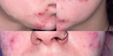 Je viens de terminer 6 mois sur Accutane - Voici ce que j'aurais aimé savoir avant