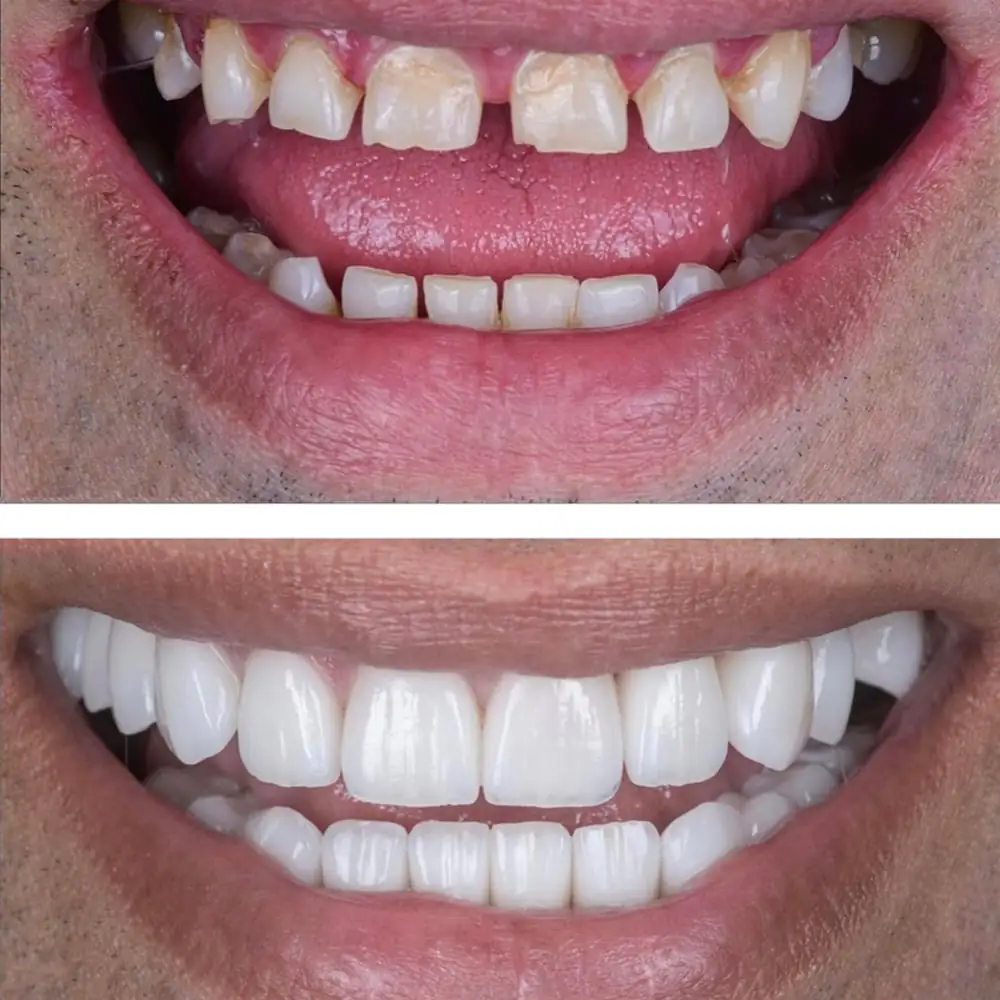 6 options pour le redressement des dents adultes