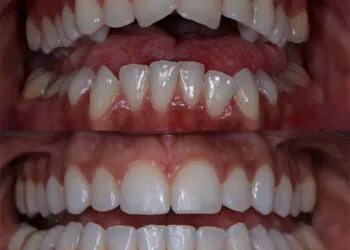 6 options pour le redressement des dents adultes