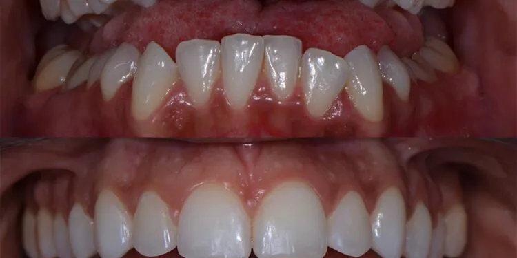 6 options pour le redressement des dents adultes