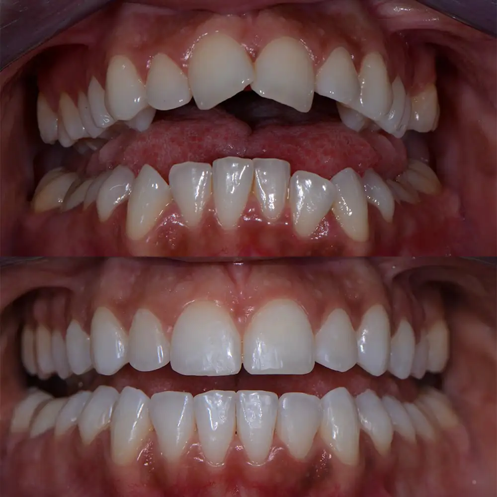 6 options pour le redressement des dents adultes