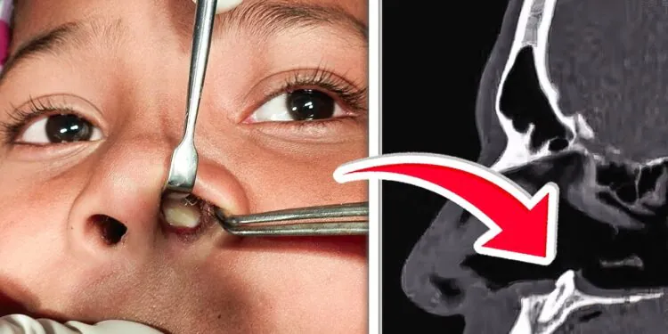 Doctors Found WHAT Growing Inside his NOSE!