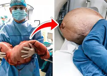 Shocked Doctors Remove 30 Pounds Of Poop Built Up For 22 Years